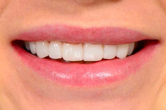 Veneers Newton Dentistry Ma 1523